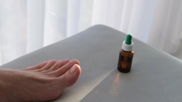  A close-up of a foot with a fungus on the nails . Onycholysis: detachment of the nail from the nail bed.