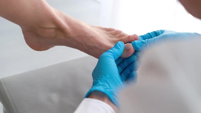 A close-up of a foot with a fungus on the nails is examined by a doctor in gloves. Onycholysis: detachment of the nail from the nail bed.