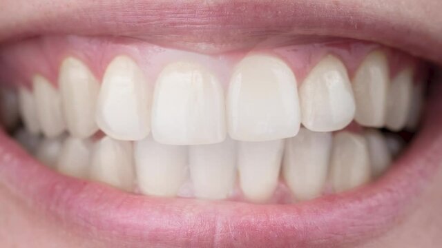 Close-up of a woman's smile before and after teeth whitening.