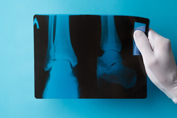 A concept in the field of a healthy lifestyle. A doctor in a white glove holds a close-up X-ray of the patient's leg against a turquoise background. Providing medical care for bone diseases.