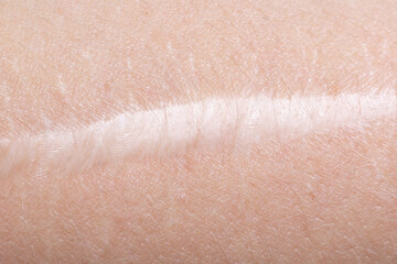 Fototapeta na wymiar scar on the skin of the hand