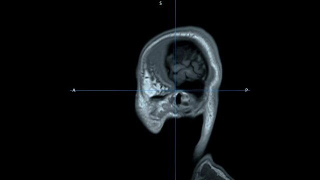 Structural T1 weighted MRI Magnetic Resonance Imaging scan of skull and brain tissue