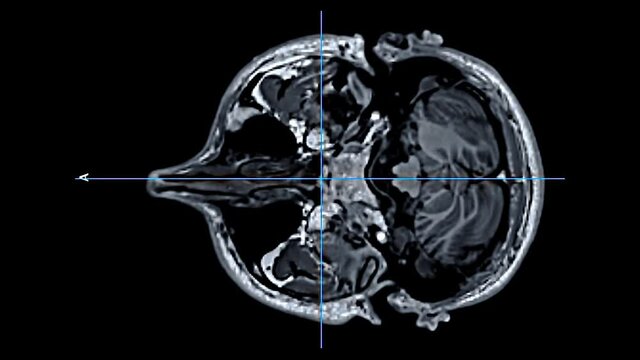 Structural T1 weighted MRI Magnetic Resonance Imaging scan of skull and brain tissue