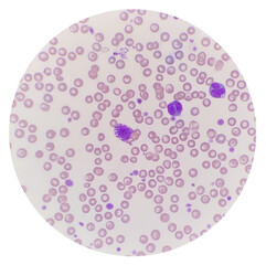 Peripheral blood showing mast cell and two monocyte. Leukocyte with a large round nucleus and numerous dark purple or blue cytoplasmic granules, mast cell. - obrazy, fototapety, plakaty