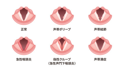 喉頭の疾患のイラスト素材セット © ふわぷか