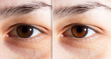 increase in brightness in the iris of the eye. Before and after beauty care for a brighter eye