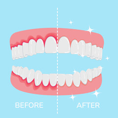 Vector of teeth and gums, healthy and affected by periodontitis.