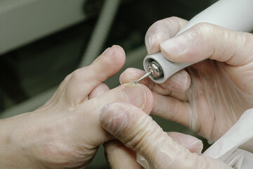 treatment of a diseased nail in the doctor's office