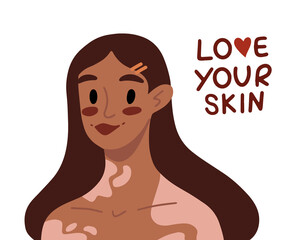 Young dark skin woman with vitiligo. Support people with chronic skin disorder. Beauty is diversity. Self acceptance, self love concept. Poster, banner, card international World Vitiligo Day