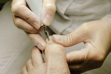 doctor's hands remove a nail with a medical drill
