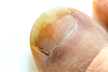 Fototapeta premium onychomycosis, The initial stage of mycosis. Big toe infected with fungal bacteria, Close up, White background