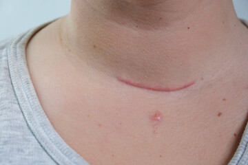 Scar on the neck. surgical wounds, removal of tumor and thyroid cancer. Red scar on the larynx, cut on the skin. Surgery and treatment Thyroidectomy, Hemithyroidectomy, Hashimoto's thyroiditis - obrazy, fototapety, plakaty