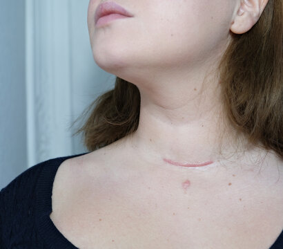 Scar On The Neck. Surgical Wounds, Removal Of Tumor And Thyroid Cancer. Red Scar On The Larynx, Cut On The Skin. Surgery And Treatment Thyroidectomy, Hemithyroidectomy, Hashimoto's Thyroiditis