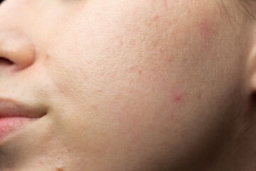 Closeup of acne-prone skin with scarring and post-inflammatory erythema after isotretinoin...