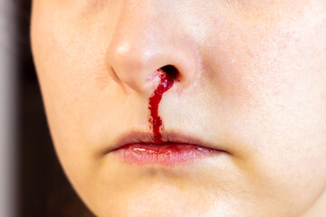 Woman face with a nosebleed close up. Bleeding nose with a red blood as an injury after accident case or disease symptom.