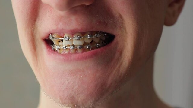 Man with crooked ugly teeth smiles with braces on teeth and turns head