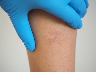 Patients with thrombocytopenia until the bleeding under the skin as red blood spots. closeup photo, blurred.
