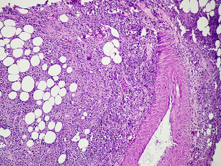 Urinary bladder cancer: microphotograph transitional cell carcinoma, high grade, malignant...