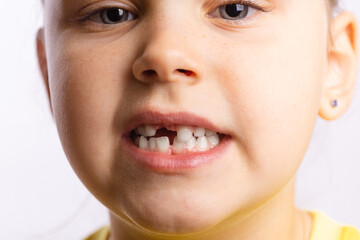 Close-up of young girl face showing missing front baby tooth looking at camera on white background. First teeth changing going to dentist to do tooth treatment. 