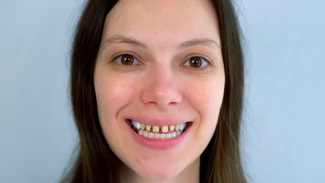 Portrait of woman with yellow bad teeth is smiling and looking at camera. Teeth sharpened by a dentist before installing crowns and ceramic veneers. Dentistry treatment, prosthetics of teeth concept.