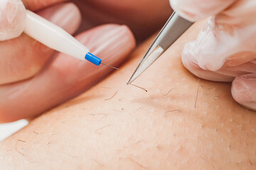 The process of permanent hair removal, using an electroepilation device and tweezers