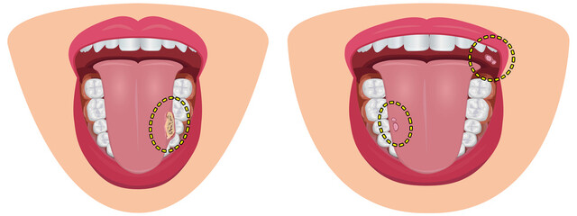 口内炎　舌がん