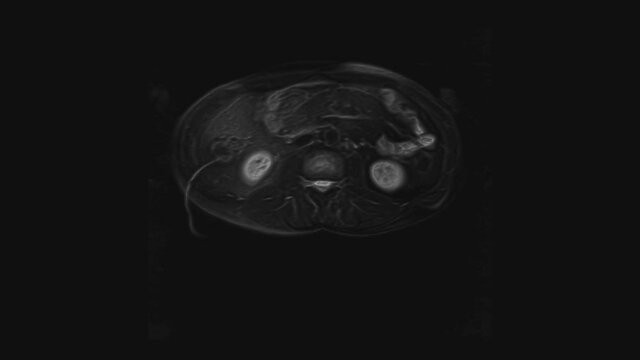 Voluminous CT scan of the abdomen. Computed tomography of the gastrointestinal tract, liver and kidneys