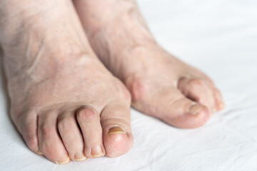 Bunions on feet of senior woman with hammer toes and dry skin over white background. Hygiene,...