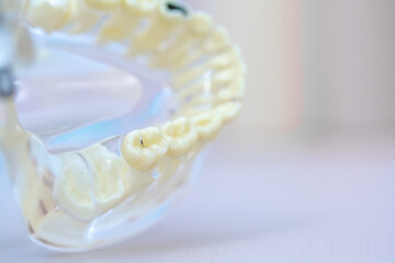 Silicone transparent model of the human jaw, lower teeth, the mark of the diseased tooth is marked...
