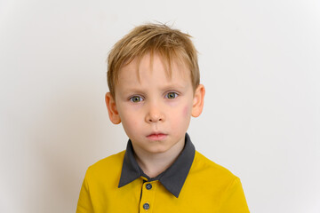 A hematoma on the face under the boy's left eye. Injury in a fall. The boy looks directly into the camera