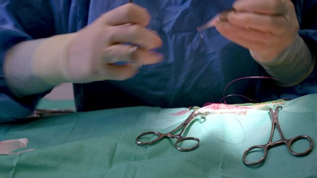 Surgery operation. Close up of surgeon hands stitching the wound after operating. Surgical treatment concept. Surgeon hands performing operation with surgery tools. High quality 4k footage