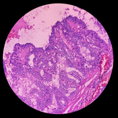 Cervical lymph node cancer: Microscopic image of metastatic papillary carcinoma of thyroid, microscopic 40x view.