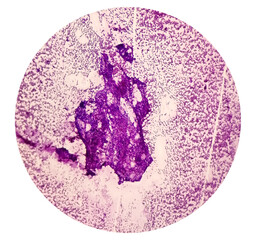 Photomicrograph of fine needle aspiration (FNA) cytology of a pulmonary (lung) nodule showing...