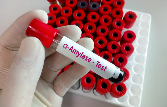Biochemist or Lab Technologist holds Blood sample for Alpha Amylase enzyme test. Diagnosis of pancreatitis in the laboratory