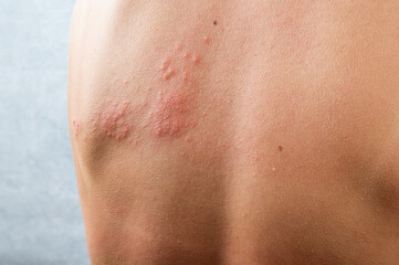 chickenpox rash. Shingles, varicella-zoster virus. skin rash and blisters on body. Skin infected Herpes zoster virus. Herpes Virus on body. urticaria rash. atopic dermatitis - obrazy, fototapety, plakaty