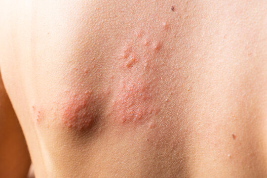 chickenpox rash. Shingles, varicella-zoster virus. skin rash and blisters on body. Skin infected Herpes zoster virus. Herpes Virus on body. urticaria rash. atopic dermatitis
