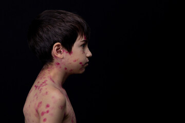 Chickenpox varicella scabies, sick child boy 8 years old with skin disease. Chickenpox varicella...
