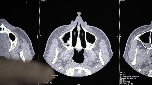 Computer tomography of paranasal sinuses.mov