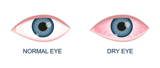 Human eye healthy and dry. Normal and inflamed bloodshot eyeball with irritation and red conjunctiva. Symptoms of keratitis, allergy, conjunctivitis, uveitis. Vector cartoon illustration.