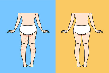 Back view of woman in underwear before and after cellulite removal. Female lower body legs and ass have anti-cellulite procedure or treatment. Body shape and healthcare. Vector illustration.  - obrazy, fototapety, plakaty