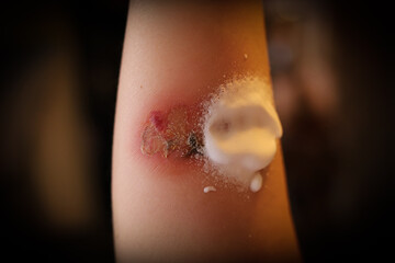 burn on the hand, treatment, first aid, application of medicine