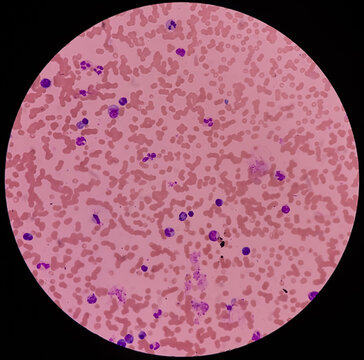 Microscopic view of blood film, plasma cell leukemia, plenty atypical cells, rouleaux formation present. microscopic 40x view