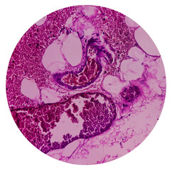 Tissue from gallbladder cyst, microscopic image of choledochal cyst, selective focus, 40x view