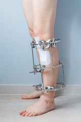 leg in Ilizarov's external fixator, Ilizarov's apparatus