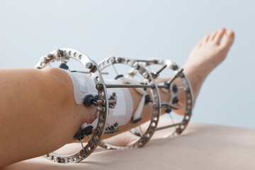 leg in Ilizarov's external fixator, Ilizarov's apparatus