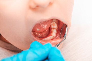 A dentist examines a tooth affected by caries in a child using a dental mirror.