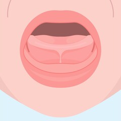 Tongue tie top lip bottle feeding sore damaged nipples issue care nurse Breast oral colic milk supply dentistry Torn frenuloplastika thrust frenulotomy frenulectomy nursery abnormal removal baby