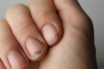 damaged damaged nail without manicure with dirt close-up. Nail Health Care - obrazy, fototapety, plakaty
