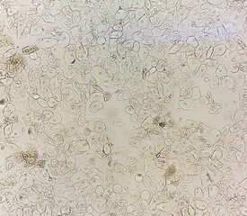 Photomicrographic close view of Abnormal urine analysis. Epithelial cell, Pus cell.