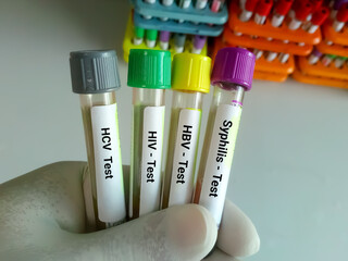 Blood samples for Sexually trasmitted disease. HIV, HCV, HBV, Shiphilis